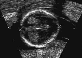 Soft Markers Of Chromosomal Aberrations Radiology Key