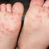 Fungus on feet can be prevented by following some simple steps revealed in this article. 1