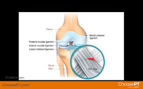 The anterior cruciate ligament (acl) is one of a pair of cruciate ligaments in the human knee. Guide Physical Therapy Guide To Anterior Cruciate Ligament Tear Choose Pt