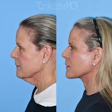 Here's an explanation behind the process of Fractional eCO2 laser with PRP  after my patient's face and neck lift⚡😌. I frequently get questions about  platelet-rich plasma (PRP) and its benefits. In summary,