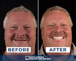 Santa Barbara Dental Implants