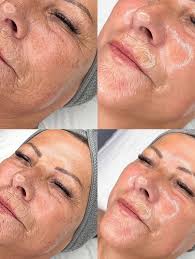 🗣️☀️We are so excited to share our HYDRAFACIAL SUMMER PROMO with you! 🌟We  are offering an amazing discounted rate