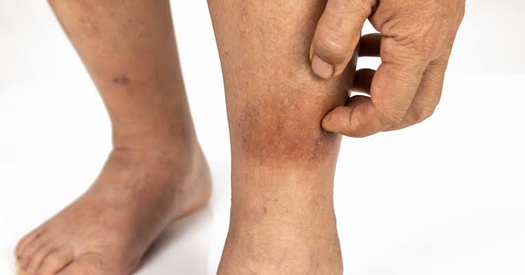 Common Causes of Venous Stasis Dermatitis