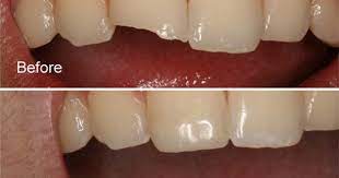 Composite Fillings In New Delhi White Tooth Coloured Fillings Dental Composite Resin Teeth Fillings In Del Tooth Filling Chipped Tooth Repair Chipped Tooth