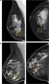 How does a ct scan (cat scan) work? International Evaluation Of An Ai System For Breast Cancer Screening Nature