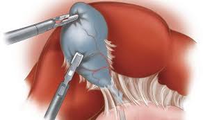 This paper describes the anatomical landmarks, indications, preoperative management and the technique of laparoscopic appendectomy. Colecistectomia Laparoscopica Operatie Fiere Bila Dr Gabriel Matei