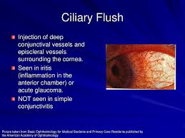 Image result for Ciliary Flush
