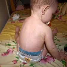 Unui copil cu infectie virala ii este permis sa se intoarca in colectivitate in cazul in care nu mai prezinta febra in ultimele 24h si se simte suficient de. Rosu In Gat Sau Rubeola Bebelu Ro