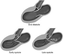 Image result for Left Ventricular Outflow Obstruction