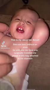 Colostomy Wheelchair