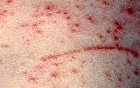 Image result for koebner phenomenon psoriasis