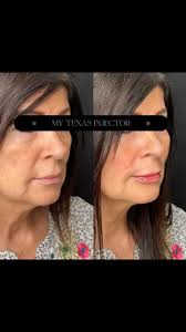the🩵”Natural Look”🩵a subtle cheek lift with a hydrating lip filler, 💋Not  blown out, plastic or botched, but rested & rejuvenated, 🥂All in good  taste with a complimentary boost of confidence