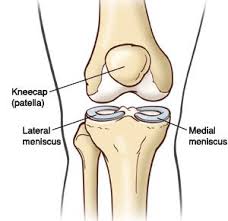 Meniscal transplant surgery is a type of surgery that replaces your missing or damaged meniscus with a meniscus from a cadaver donor. The Knee Meniscus Torn Between Rehab Or Surgery Newcastle Sports Medicine