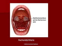 In den ländern der gemeinschaft unabhängiger staaten kommt es seit den 1990er jahren wiederholt zu größeren ausbrüchen. Diphtherie Med Kom