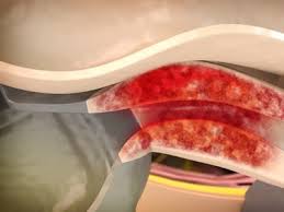 Maybe you would like to learn more about one of these? Morbus Crohn Symptome Ernahrung Behandlung Ndr De Ratgeber Gesundheit