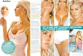 Heidi montag's transformation after 10 plastic surgeries. Heidi Montag S Body Is Scarred From Her 10 Plastic Surgeries