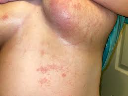 Image result for Candidiasis under breasts
