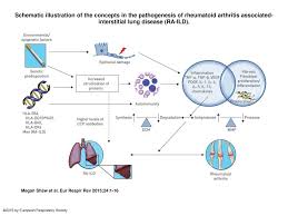 Schematic Illustration Of The Concepts In The Pathogenesis Of Rheumatoid Arthritis Associated Interstitial Lung Disease Ra Ild Schematic Illustration Ppt Download