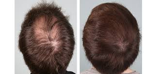 Vampire hair loss treatment prp hair treatment has been gaining prominence in the last few years, but has been around for some time. Platelet Rich Plasma Prp Hair Restoration Northwest Aesthetics