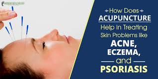 acupuncture for skin problems treat acne eczema and