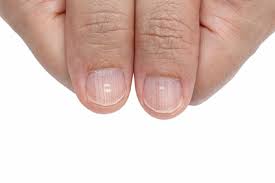 Behandeln kannst du diese weißen flecken nicht. Weisse Flecken Auf Fingernagel Nagel Paradies