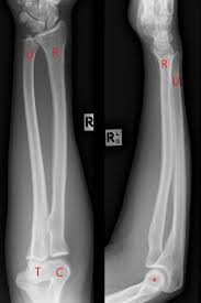 The ulna is usually slightly longer than the radius, but the radius is thicker. Midshaft Radius And Ulna Fractures