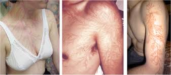 Lightning bolts are frequently used to symbolize power and the gods, but there are. Seriously Strange Ar Twitter The Electrical Discharge Of A Lightning Strike Can Leave A Tattoo Like Marking Or Scar Known As A Lichtenberg Figure Http T Co 5sm9tm7aui