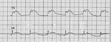 Evangelisches krankenhaus kalk, köln kardiologie & internistische intensivmedizin. Reversibler Totaler Av Block Durch Mikroaxiales Herzpumpensystem Swiss Medical Forum