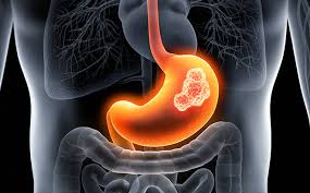 Stomach Cancer (Gastric Cancer): How to Prevent, Risks and Treatment -  HealthXchange.sg