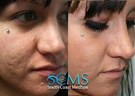 Bio Oil Before After Acne Scars Laser Skin Resurfacing Before And After Laser Skin Resurfacing Laser Skin Laser Skin Treatment