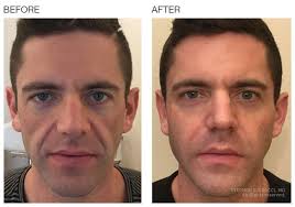 Before And After Baselift Botox Cosmetic Cosmetic Treatments Facelift Before And After