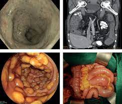 Consult a doctor for medical advice. Endoscopic Surgical And Radiological Images Of Severe Clostridium Download Scientific Diagram