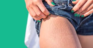 8 Home Remedies For Stretch Marks