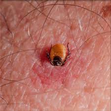 Image result for infected tick bite