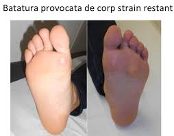 Bataturile sunt acele formatiuni epidermice tari ce se fac pe degetele de la picioare sau pe talpa. Bataturile Piciorului Cauze Si Tratament