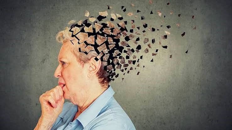 Bệnh mất trí nhớ Alzheimer: Nguyên nhân và dấu hiệu nhận biết
