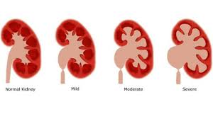 Epidemiologi penyakit ginjal kronis m. Penyakit Ginjal Kronis Pgk Menurut Para Cendikiawan Ulya Days