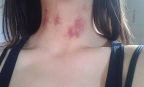 ما لا تعرفه عن البقع الحمراء ما بعد التقبيل المدينة نيوز