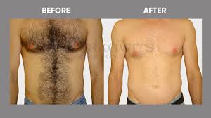 Don't let money stop you from banishing that unwanted body hair. Body Laser Hair Removal Cost Off 63 Online Shopping Site For Fashion Lifestyle