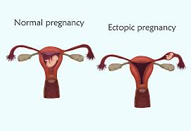 10 Reasons For Menstrual Cramps But No Period