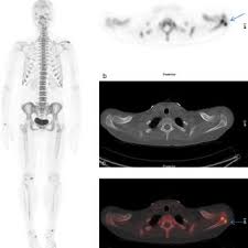 While 90% of such lumps are not cancerous, it is vital to get them checked by your gp at the earliest. A 42 Year Old Female With Right Sided Breast Cancer And Severe Left Download Scientific Diagram