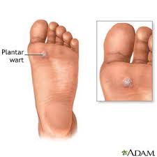 So you've got a deformity in your toe where it bends or points downward and causes pain and discomfort? Plantar Wart Discharge Care What You Need To Know