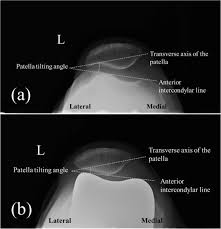 Image result for Patellar Tilt Test