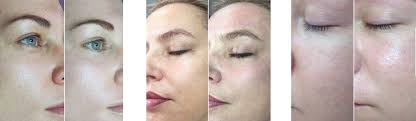 See more ideas about glow, skin treatments, led light therapy. Bb Glow No Make Up Look