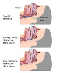 Image result for Sleep Apnea