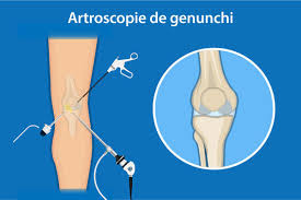 Majoritatea rupturilor acestui ligament sunt totale și se asociază cu leziuni ale altor structuri de la nivelul genunchiului: Artroscopia De Genunchi Reginamaria Ro