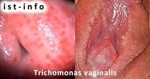 Image result for trichomonas images