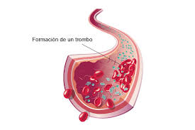 Qué es un trombo y qué importancia tiene? Hospital Cruz Roja de Córdoba