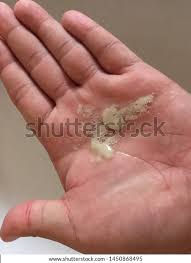 Image result for phlegmon of hand)