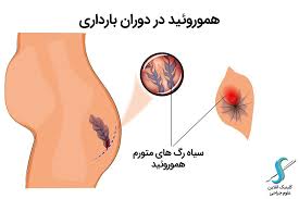 هموروئید و شقاق در بارداری